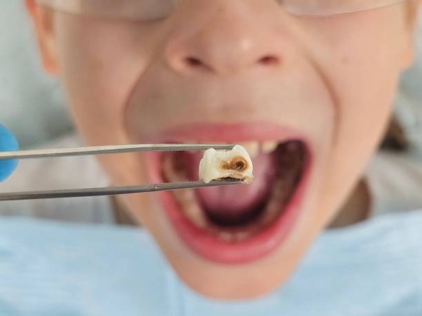 Best Broken Tooth Emergency  in Pleasant Grove, OH